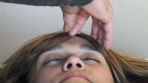 Patient receiving acupuncture on their forehead.