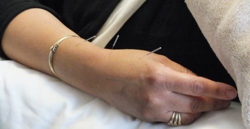 Patient receiving acupuncture on their hand and wrist.